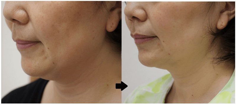 左がBEFORE、右がAFTER