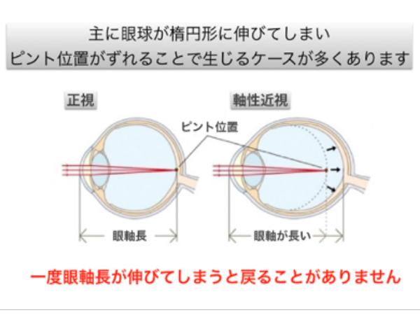 主に眼球が楕円形に伸びてしまい、ピント位置がずれることで生じるケースが多くあります。